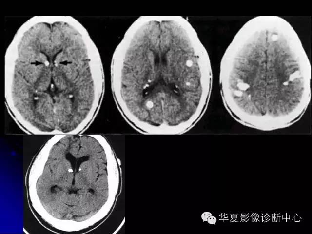 【PPT】颅脑先天发育畸形