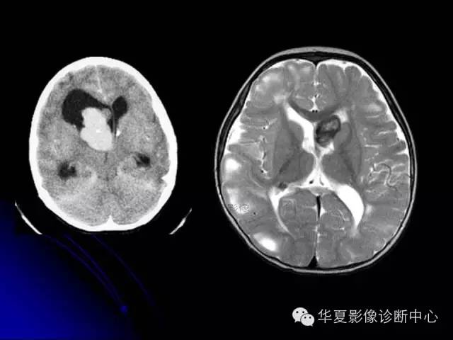 【PPT】颅脑先天发育畸形