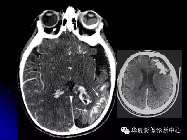 【PPT】颅脑先天发育畸形