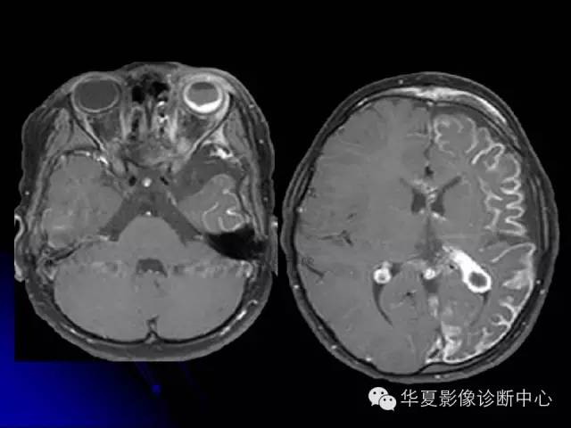【PPT】颅脑先天发育畸形