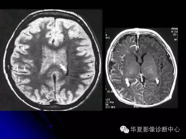 【PPT】颅脑先天发育畸形