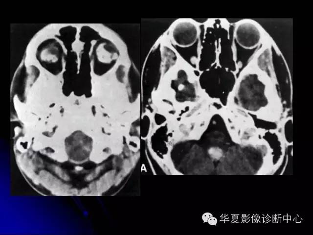 【PPT】颅脑先天发育畸形