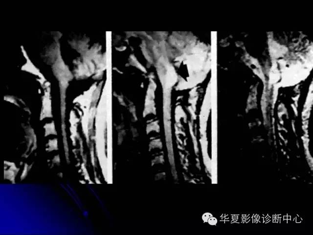 【PPT】颅脑先天发育畸形