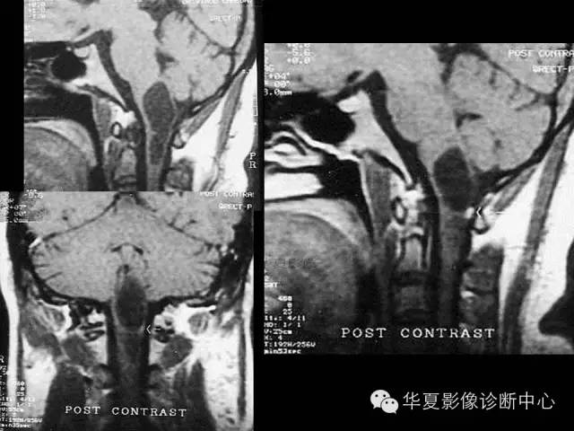 【PPT】颅脑先天发育畸形