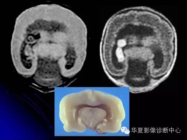 【PPT】颅脑先天发育畸形