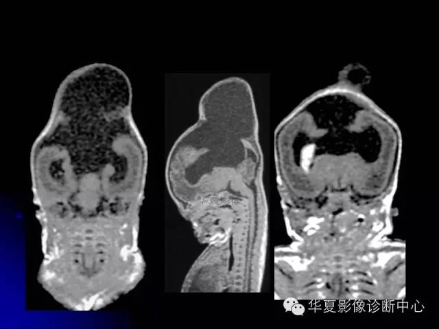 【PPT】颅脑先天发育畸形