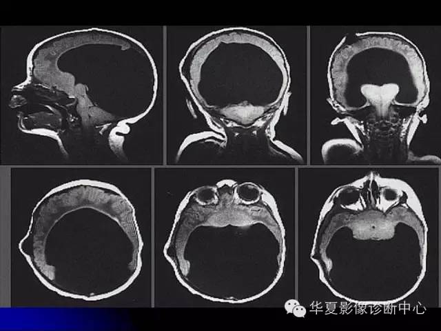 【PPT】颅脑先天发育畸形