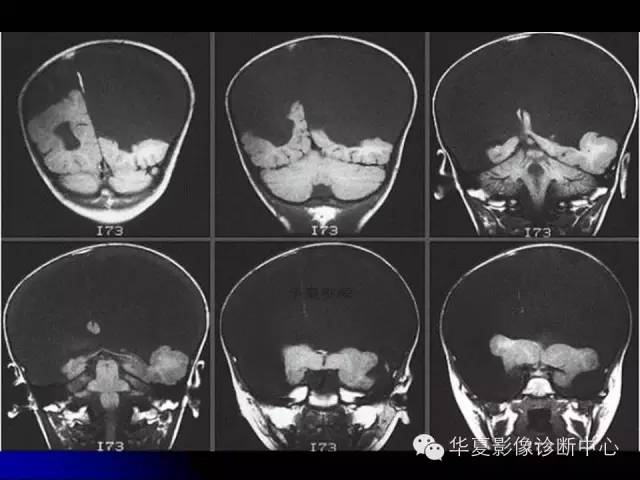 【PPT】颅脑先天发育畸形