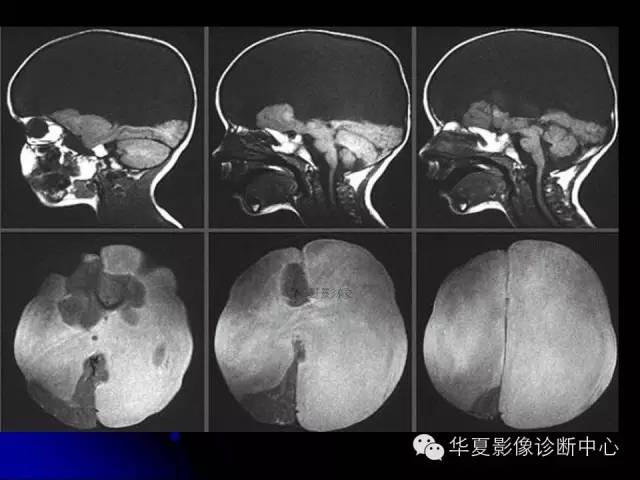 【PPT】颅脑先天发育畸形