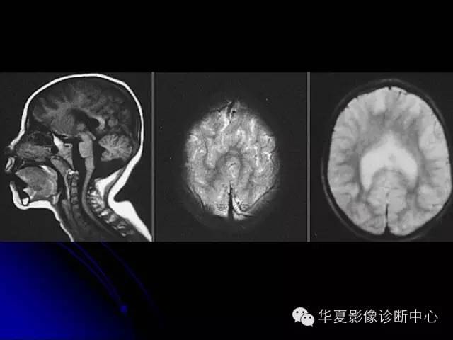 【PPT】颅脑先天发育畸形