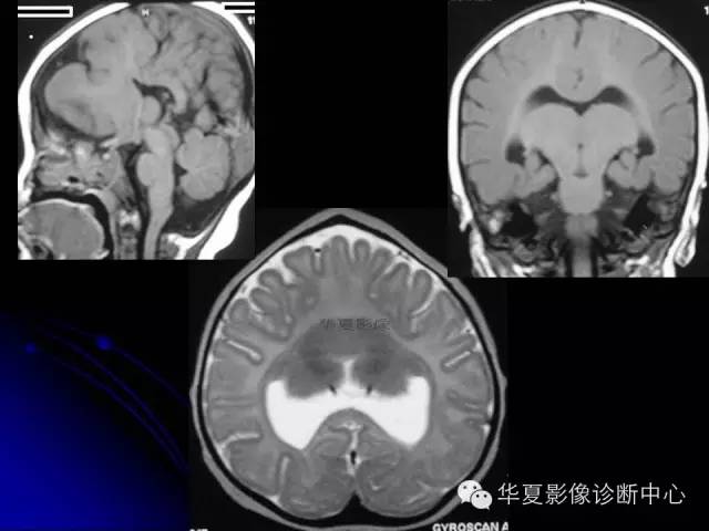 【PPT】颅脑先天发育畸形