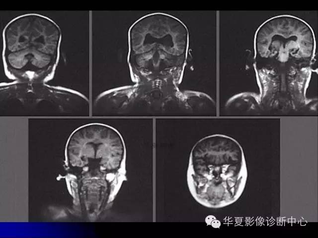 【PPT】颅脑先天发育畸形