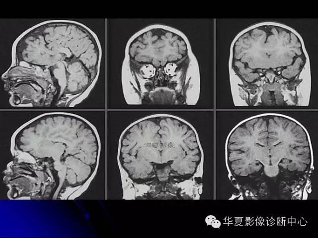 【PPT】颅脑先天发育畸形