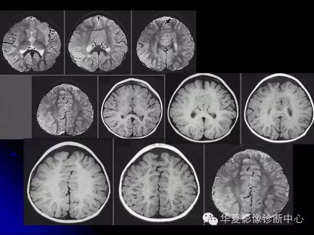 【PPT】颅脑先天发育畸形