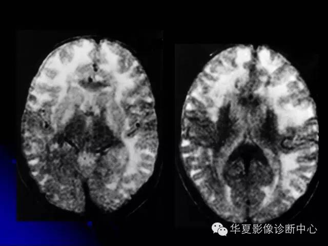 【PPT】颅脑先天发育畸形