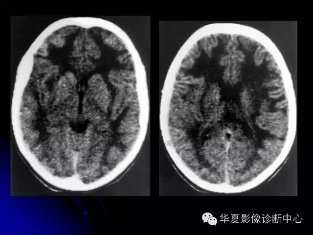 【PPT】颅脑先天发育畸形