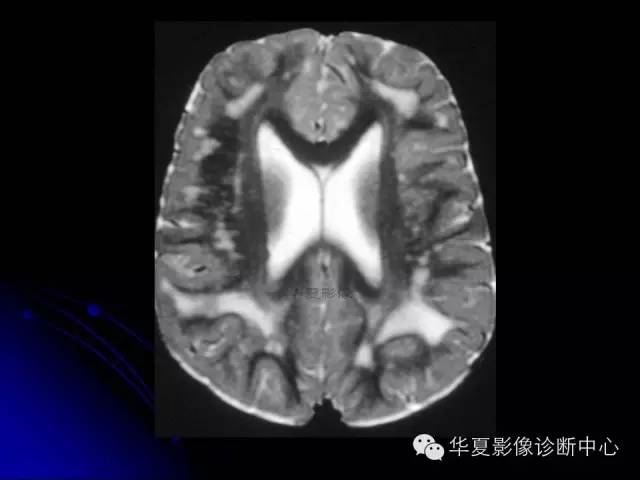 【PPT】颅脑先天发育畸形