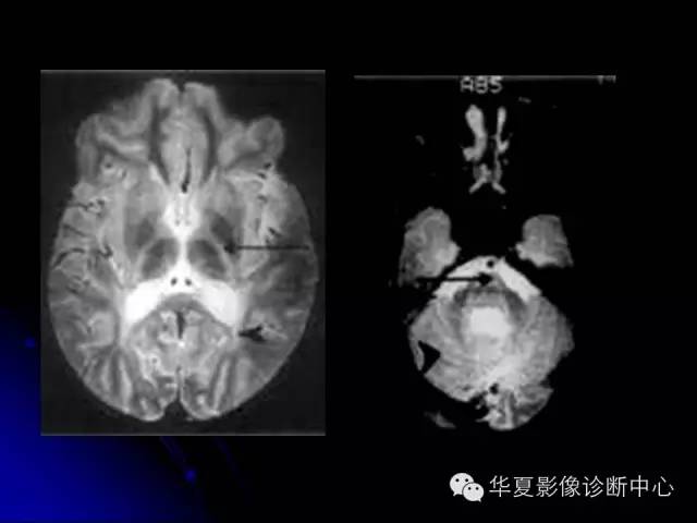 【PPT】颅脑先天发育畸形