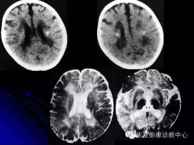 【PPT】颅脑先天发育畸形
