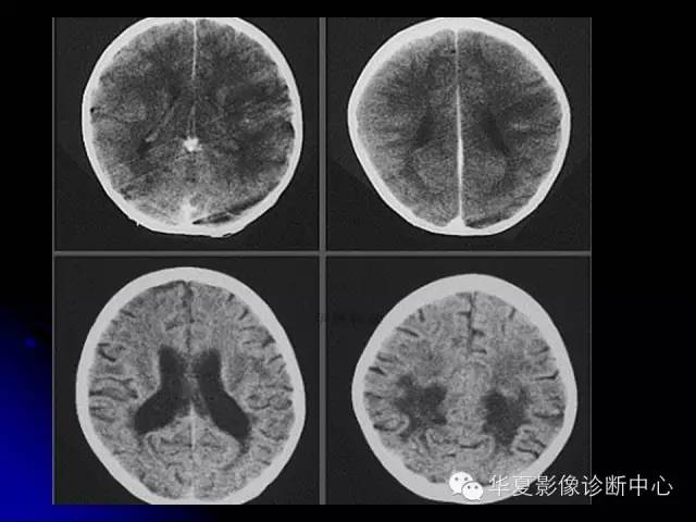 【PPT】颅脑先天发育畸形