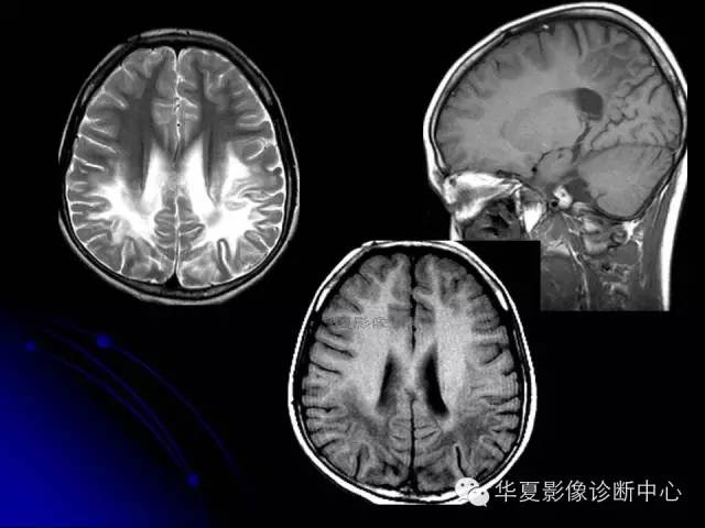 【PPT】颅脑先天发育畸形