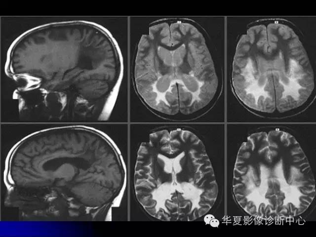 【PPT】颅脑先天发育畸形