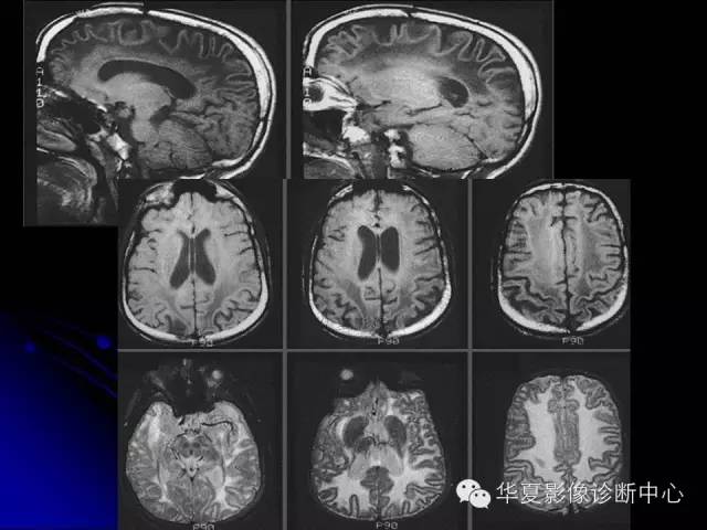 【PPT】颅脑先天发育畸形