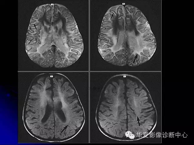 【PPT】颅脑先天发育畸形