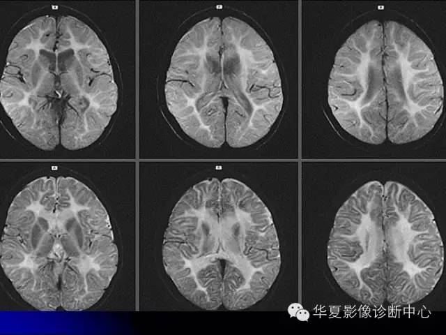 【PPT】颅脑先天发育畸形