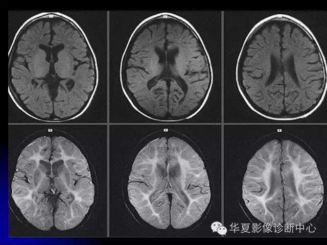 【PPT】颅脑先天发育畸形