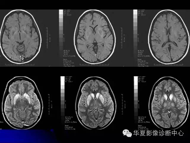 【PPT】颅脑先天发育畸形
