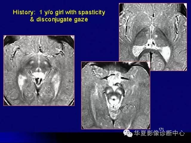 【PPT】颅脑先天发育畸形