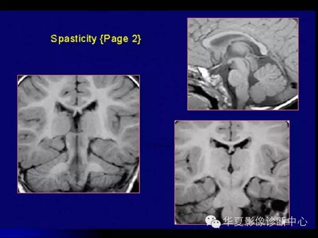 【PPT】颅脑先天发育畸形