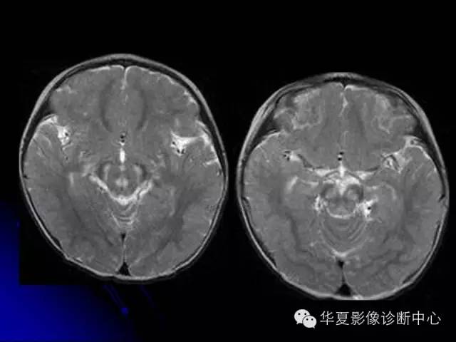 【PPT】颅脑先天发育畸形