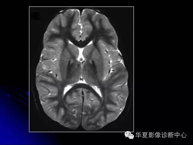 【PPT】颅脑先天发育畸形