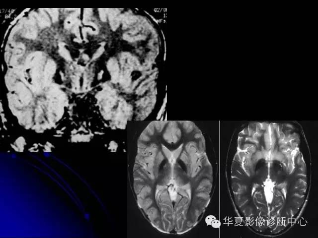 【PPT】颅脑先天发育畸形