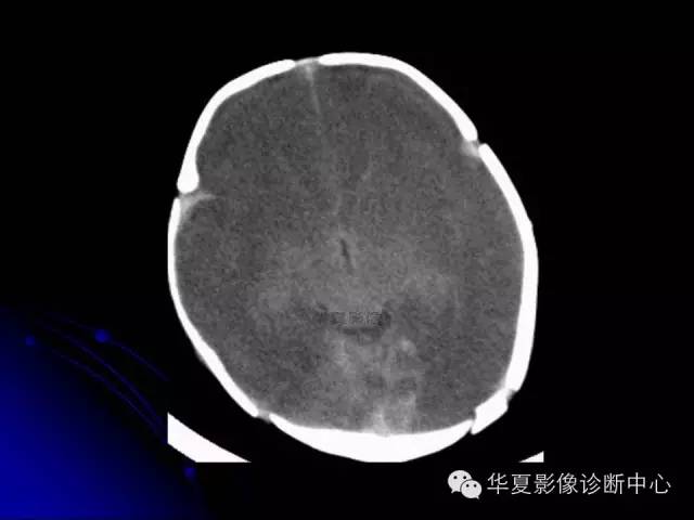 【PPT】颅脑先天发育畸形