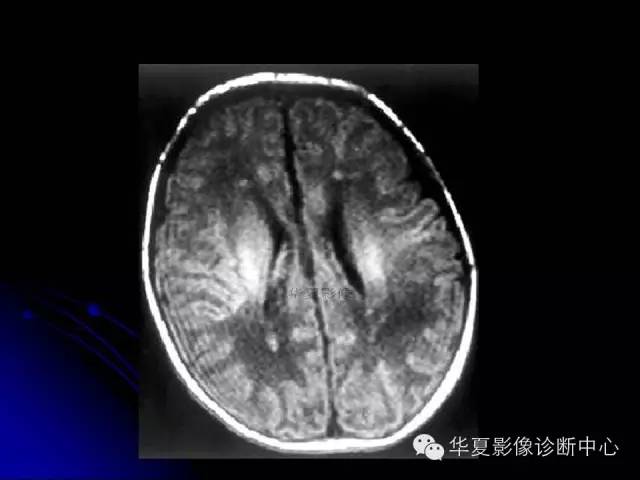 【PPT】颅脑先天发育畸形