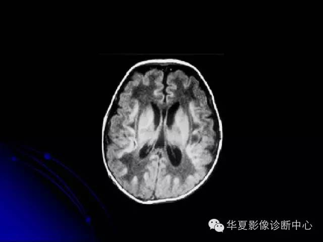 【PPT】颅脑先天发育畸形