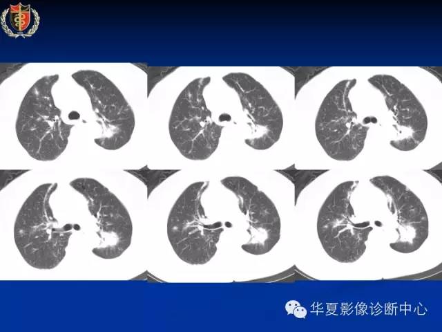【病例】肺粘膜相关性淋巴瘤1例CT影像表现