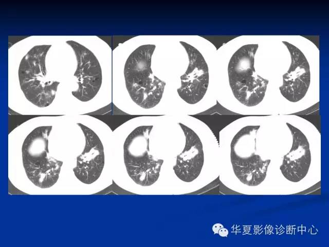 【病例】肺粘膜相关性淋巴瘤1例CT影像表现
