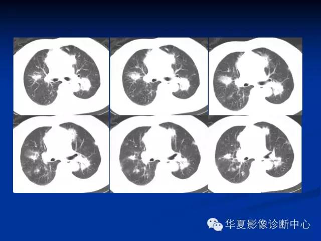 【病例】肺粘膜相关性淋巴瘤1例CT影像表现