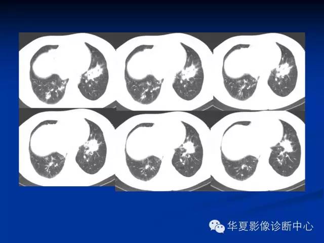 【病例】肺粘膜相关性淋巴瘤1例CT影像表现