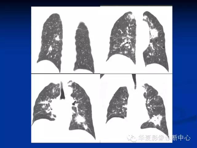 【病例】肺粘膜相关性淋巴瘤1例CT影像表现