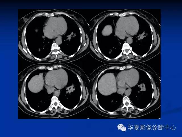 【病例】肺粘膜相关性淋巴瘤1例CT影像表现