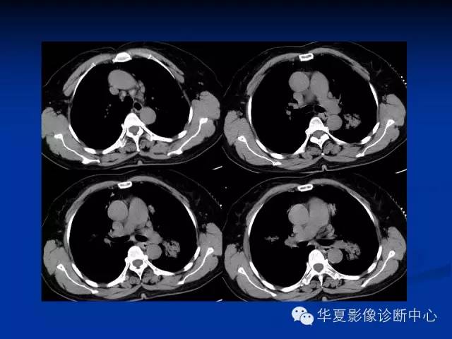 【病例】肺粘膜相关性淋巴瘤1例CT影像表现
