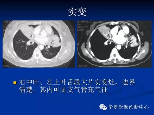 【病例】肺粘膜相关性淋巴瘤1例CT影像表现