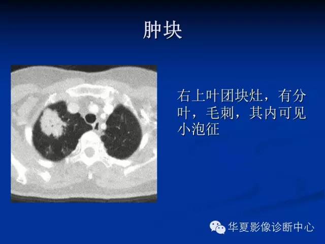 【病例】肺粘膜相关性淋巴瘤1例CT影像表现
