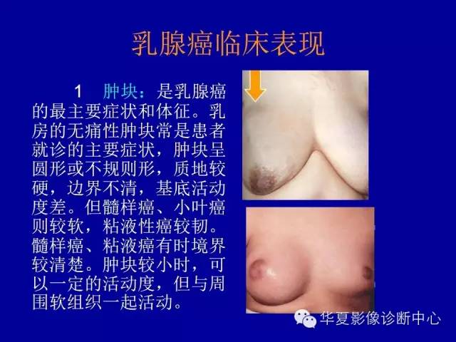 【PPT】乳腺癌的X线诊断