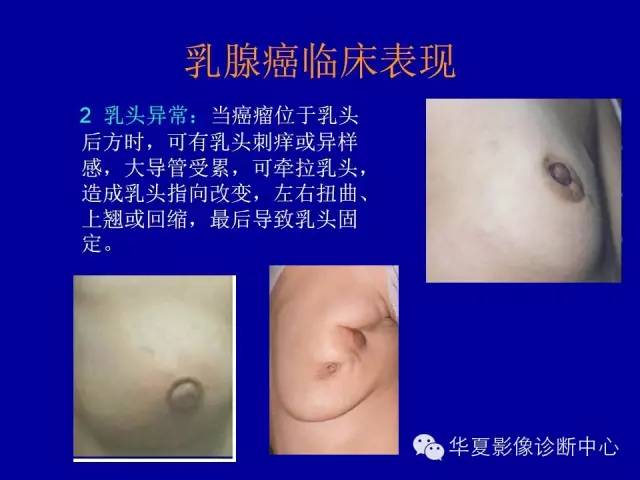 【PPT】乳腺癌的X线诊断